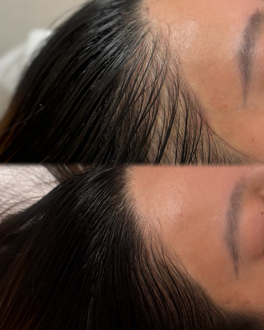 ヘアラインアートメイク 施術前後